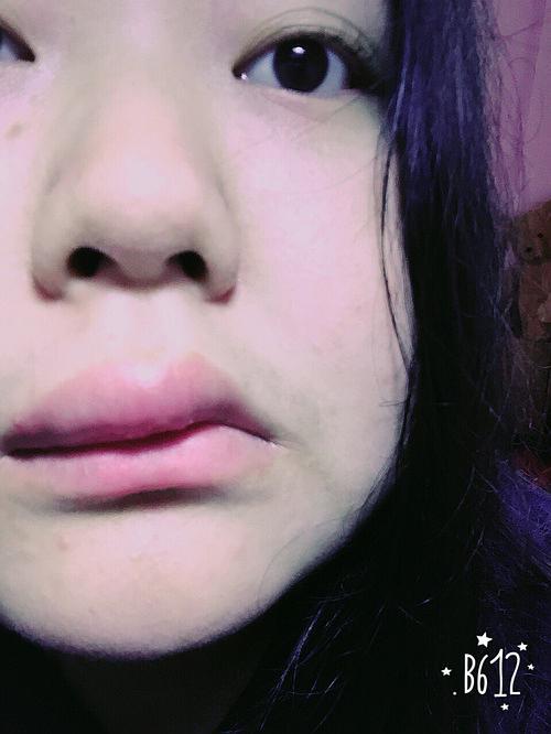 标题:【慎入】仙女们睡一觉起来嘴巴肿成这样怎么快速消肿!