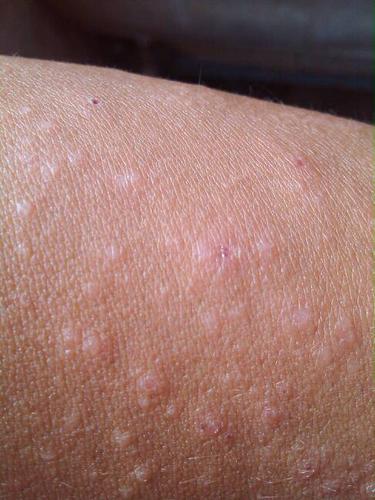 问:我这是日光性皮炎,用炉甘石洗剂后还要擦什么乳膏效果好些?