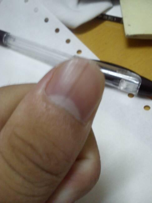 手指甲里有一条黑线是怎么回事?