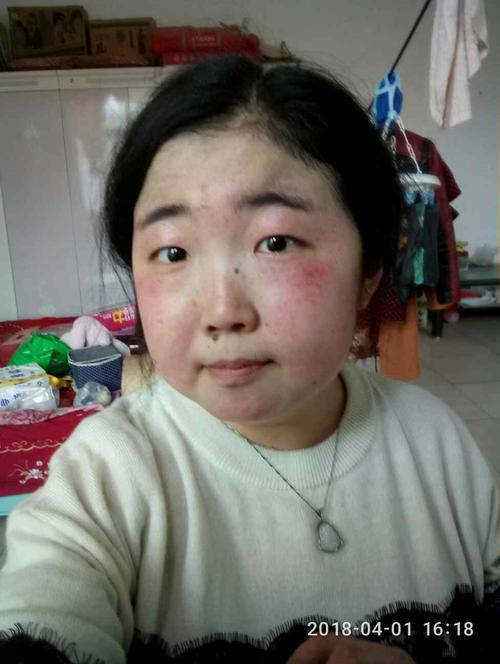 脸红-系统性红斑狼疮康复圈-觅健