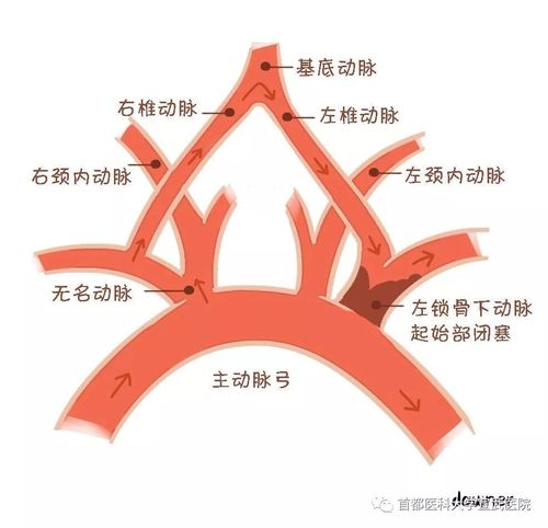 什么是"锁骨下动脉盗血综合征"