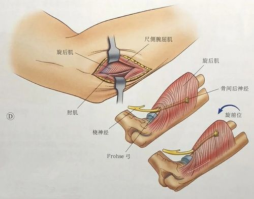 其它 桡骨头骨折的手术治疗技巧 写美篇 kocher入路:肱骨外上髁后面