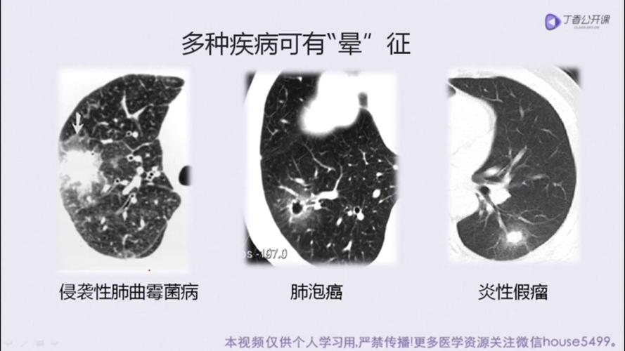 肺实质基本病变的ct解读(一)