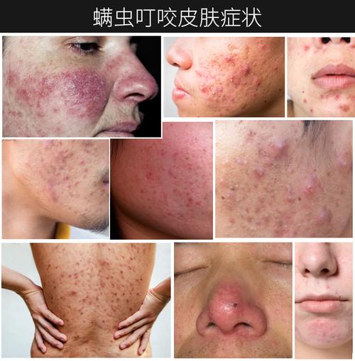 人身上被螨虫咬的图片是什么样的除螨虫效果最好的除螨皂排名