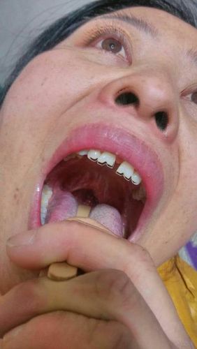 割完扁桃体就发生了这种情况,粘连,根本看不到小舌头