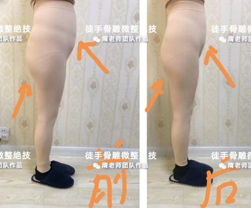 徒手身材骨雕抗衰管理为什么比市面普通骨盆闭合的效果好?