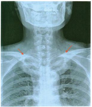 病例2就诊时胸锁关节x线显示双侧锁骨中近段明显增粗,密度增高