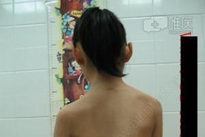 导致出现左侧胸廓发育欠佳,肺发育受限,容积下降,肺功能明显影响.