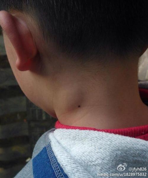 发现儿子脖子上出现一个肿块,问他说是按压.
