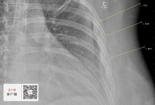 30岁女白领咳断三根肋骨 原来她把咖啡当水喝