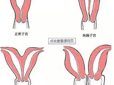 临沂治疗子宫纵隔一般多少钱