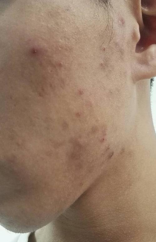 学生党想去掉这些黑色痘印,红色痘印,该怎么办