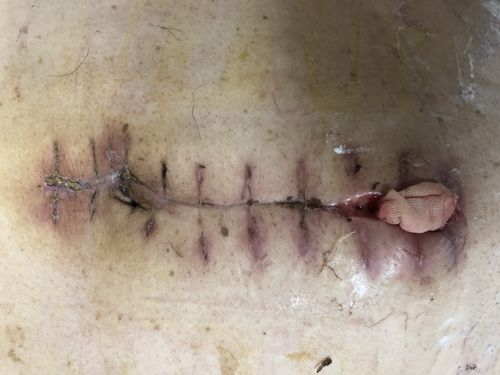 外院手术后12天,我院换药期间发现切口下积脓