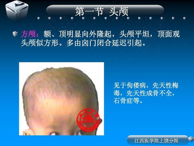 所有分类 医药卫生 临床医学 诊断学-头部检查ppt  第一节 头颅 方颅