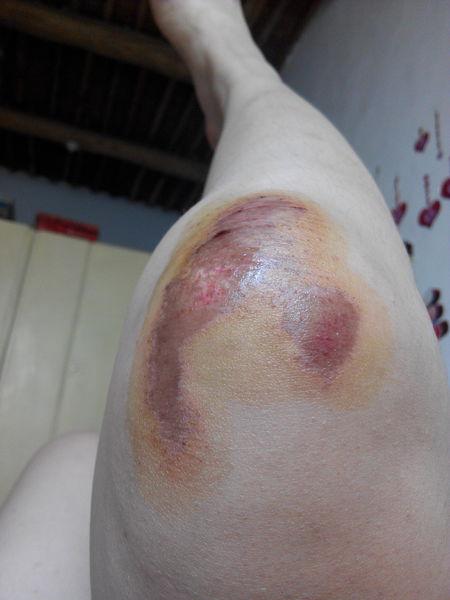 我的腿是摔伤的,第二张图是昨天拍的,还在流脓,今天早上起来腿上就成