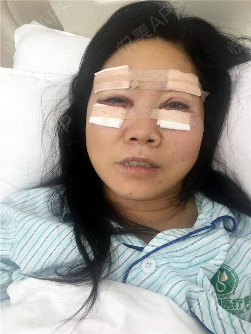 所以特意从贵州开车过来弄眼睛的,我做的是外切眼袋,切眉,内眼角