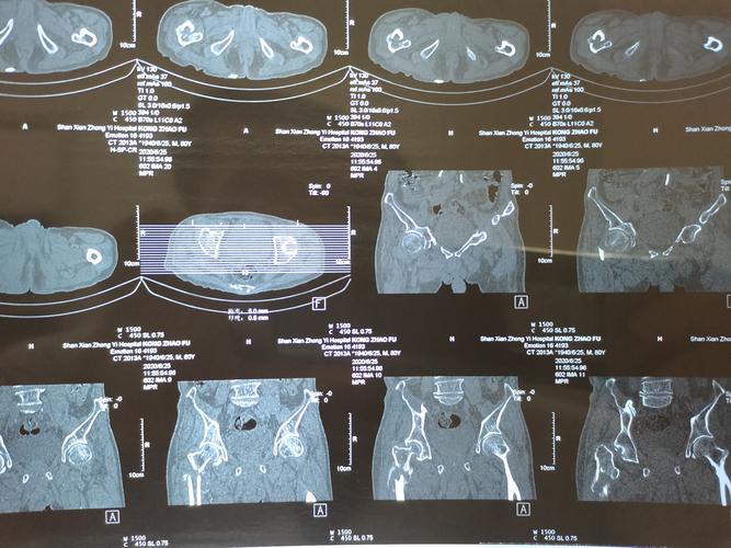 陈旧性股骨粗隆间骨折内固定