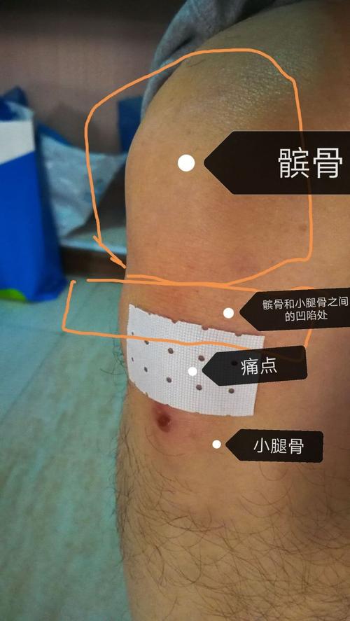 膝盖痛,经诊断为肌腱炎,20多天了没缓解,怎么办?