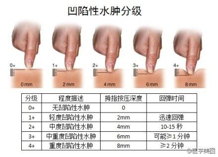 凹陷性水肿分级