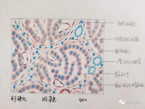 门脉性肝硬化(手绘图)