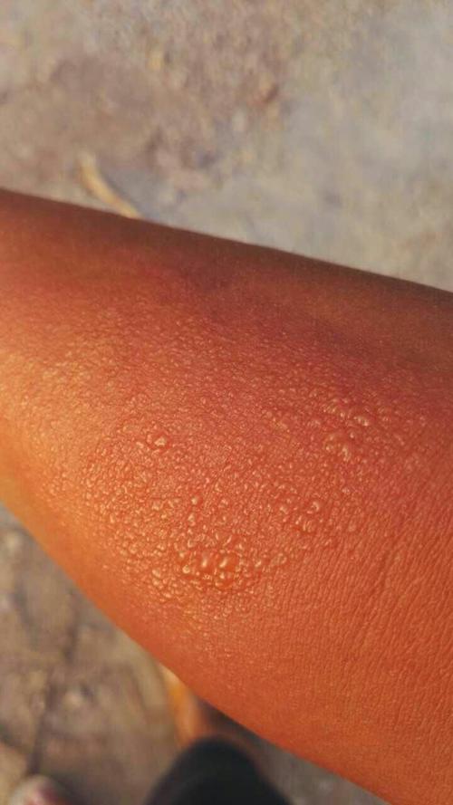 吃牛肉了就会出现这种皮肤发痒,初期整片红,奇痒无比