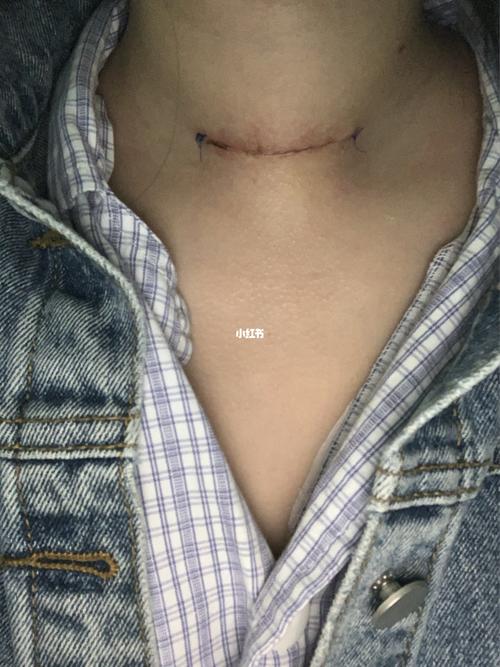 甲状腺手术后伤口更加严重_甲状腺_甲状腺手术_医疗健康_医疗健康其他