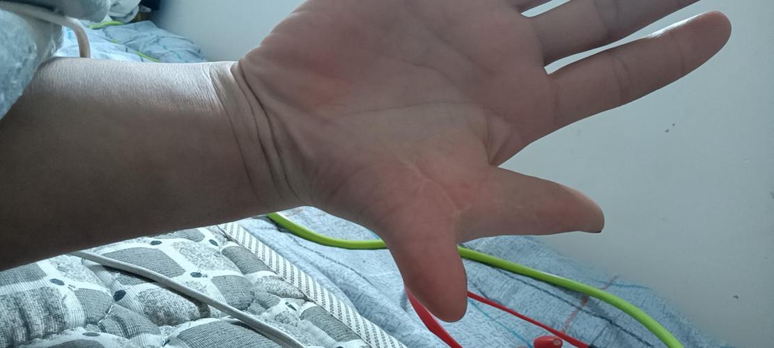 六指切除康复咨询大概需要多久可以康复