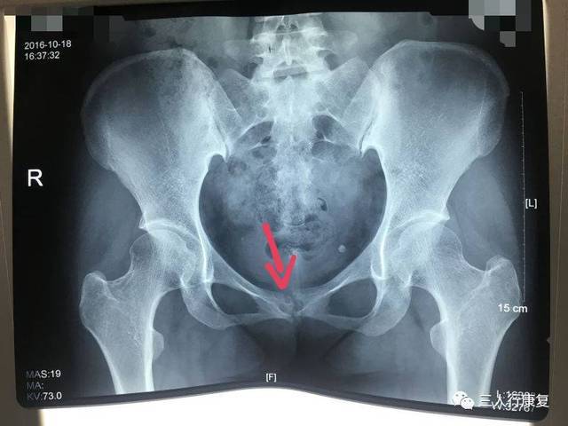 分娩诱发耻骨联合骨软骨炎1例治疗总结