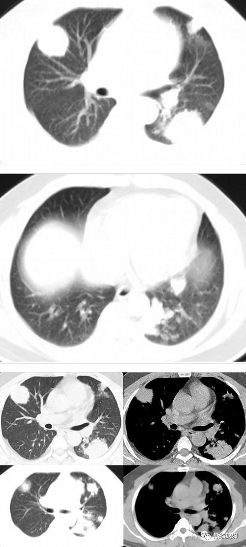 表现为多发结节的肺隐球菌病1例ct影像