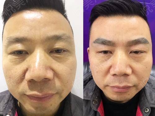 眉毛种植手术当天_面部毛发种植手术当天_毛发移植手术当天_普罗旺斯