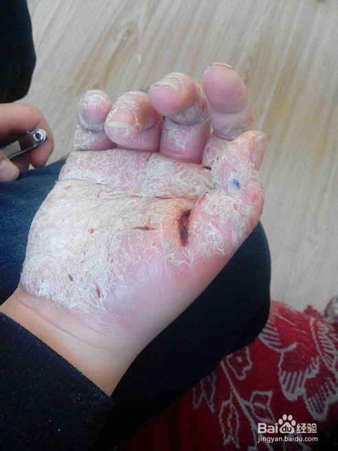 我23年银屑病自医医好的经验