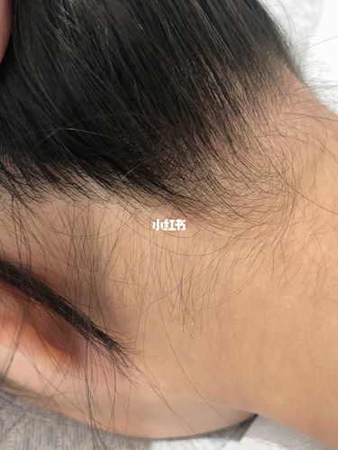 发际线 后颈脱毛_脱毛_发际线_美妆_个人护理
