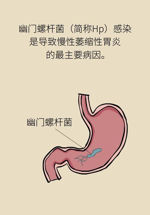 得了慢性萎缩性胃炎就离癌不远了?听听医生怎么说