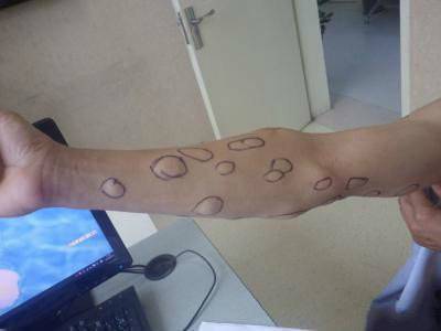 不管是单发,脂肪瘤,还是全身多发,均有恶变,可能性,但恶变可能性小.