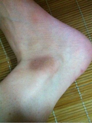 脚踝上的皮肤又黑又粗糙,比其他的皮肤都要干燥,原来以为是角质,但是