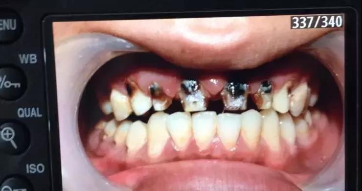 "可乐牙"是如何形成的呢?如何预防?