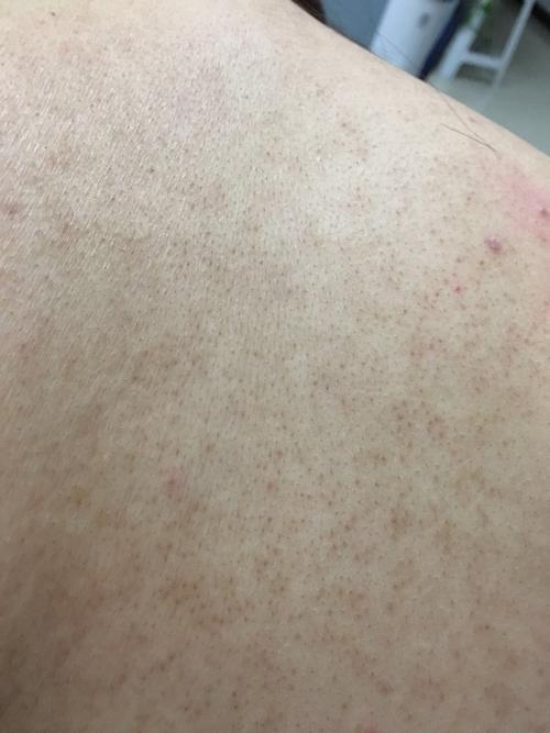 请问这种皮肤是不是毛周角化症,所谓鸡皮肤?