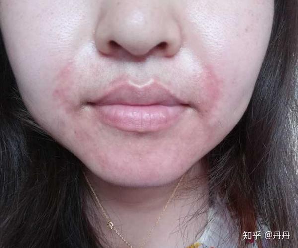 如何治疗面部脂溢性皮炎,困扰我n年了,求各位大神给我