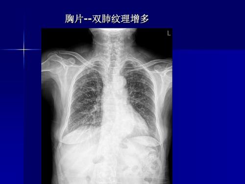 x线胸片阅读基础ppt
