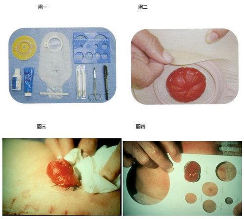 图片搜寻: 人工肛门
