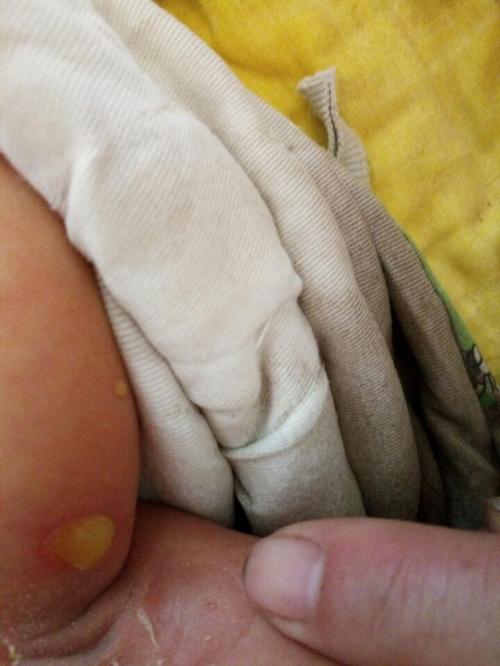 新生儿腋下有白色的脓包是怎么回事啊