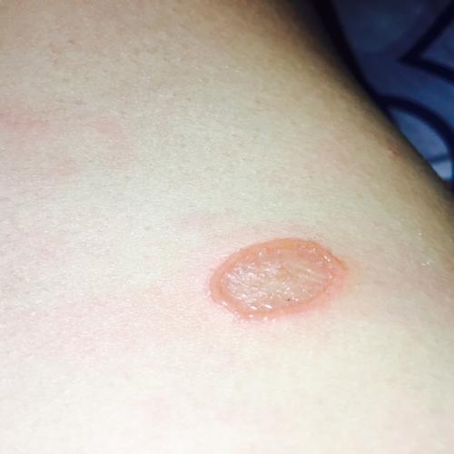 肚子上面起了一个小圆圈 开始的时候就是很痒 但是现在破了并且在流水