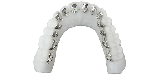 舌侧隐形矫治技术是将托槽全部安装于牙齿的舌侧面进行正畸治疗,外观