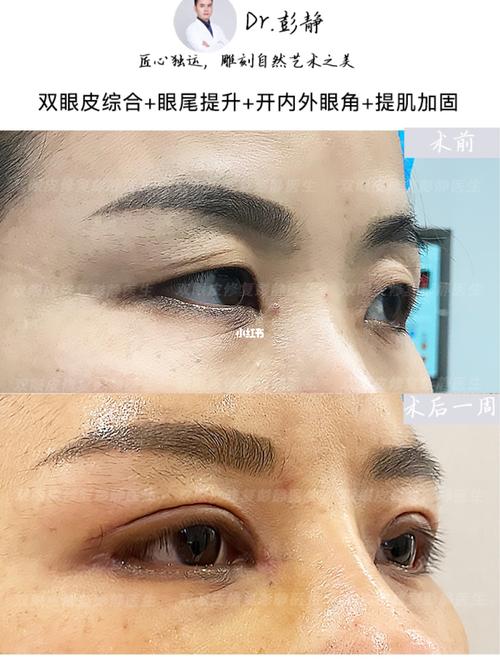 全切双眼皮手术,眼尾提升,开内外眼角_双眼皮手术_全切双眼皮_双眼皮