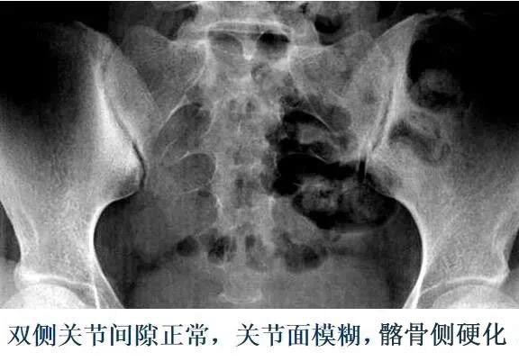 度减小 (4)"4"字试验阳性 强直性脊柱炎影像学表现 骶髂关节x线表现
