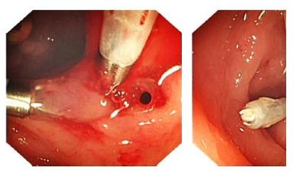胃穿孔以后不宜吃什么