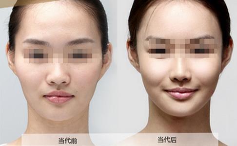 玻尿酸丰苹果肌