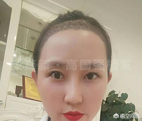 2,激光脱发际线