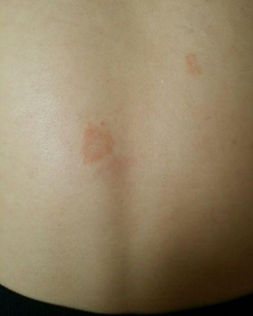 最近背部长了两块红斑,不痛不痒的什么不适的感觉都没