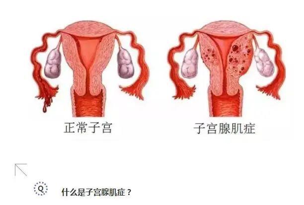 子宫腺肌症是什么有哪些症状